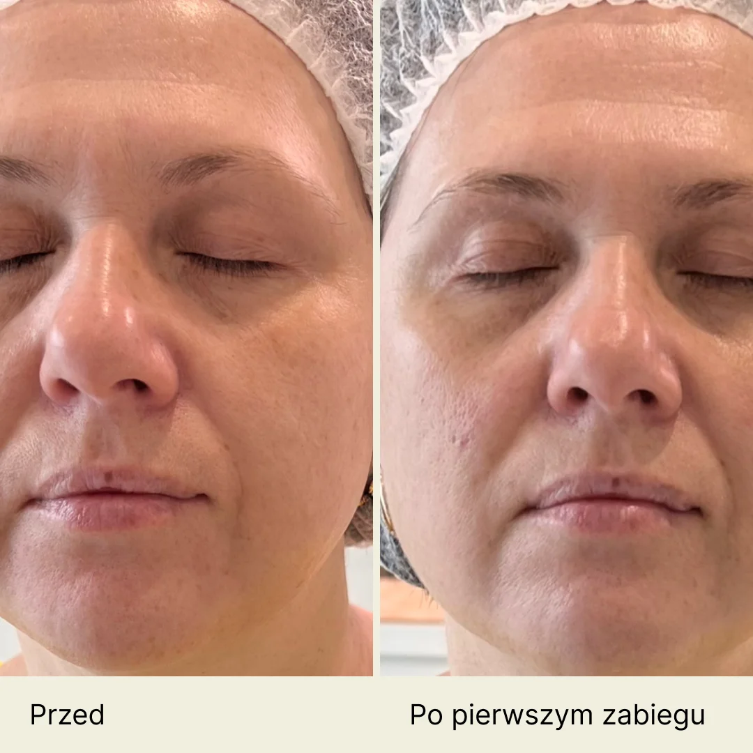 Zdjęcia porównawcze w zbliżeniu twarzy osoby przed (po lewej) i po (po prawej) zabiegu mezoterapia igłowa twarzy, z zamkniętymi oczami i wielką różnicą w gładkości i fakturze skóry. Tekst: „Przed” i „Po pierwszej operacji”.